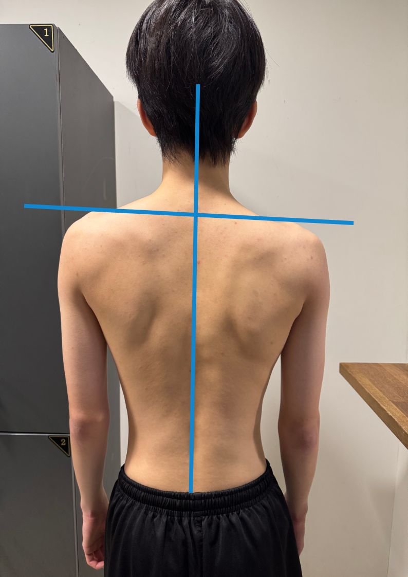 체형교정 PT 운동 전 어깨 높이 비교